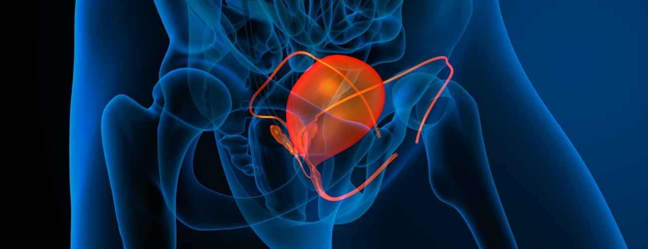 Bladder Tumor Surgery