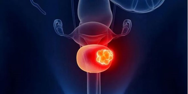 Bladder Cancer Treatment